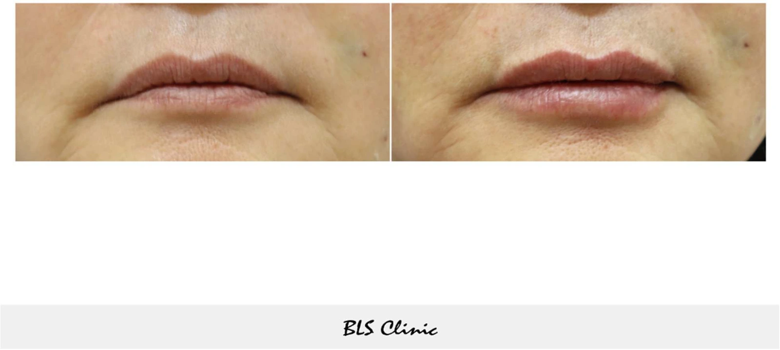 Lip fillers — lip border and fullness at BLS Clinic Myeongdong. Close-up of the lip border, mouth corners and relative fullness of both lips. Before on the left; after on the right.
