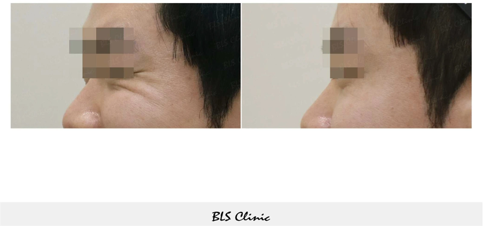 Eye-area botulinum toxin — close-up at BLS Clinic Myeongdong. Angled view of the outer eye corner and surrounding skin. Before on the left; after on the right.