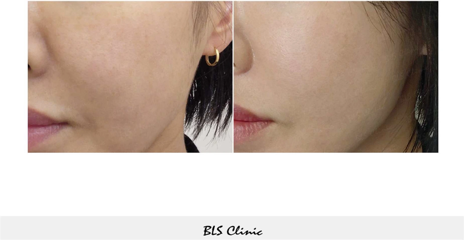 CellREDM — cheek close-up at BLS Clinic Myeongdong. Close-up of the cheek and the fold beside the mouth. Before on the left; after on the right.