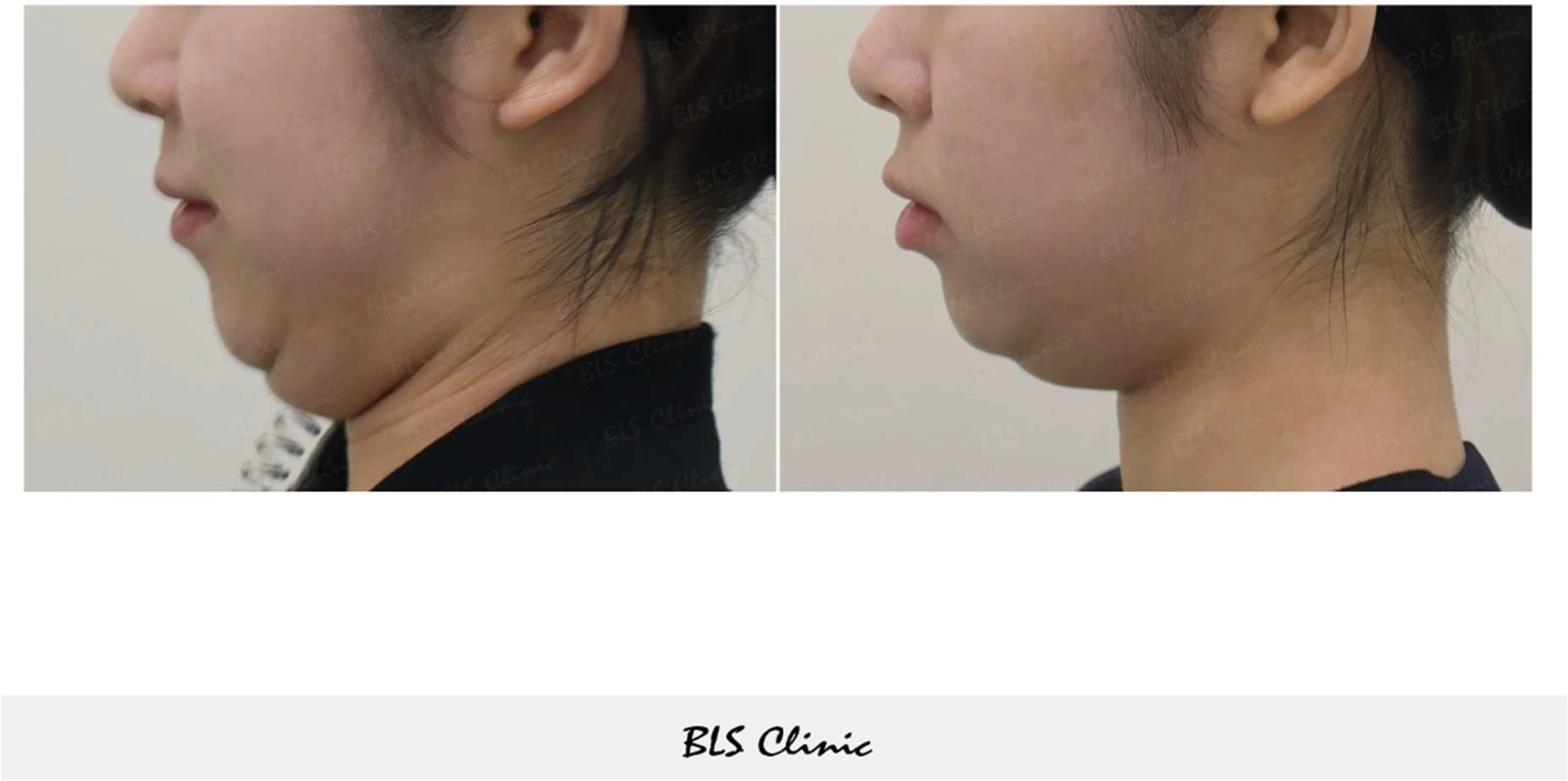 Bellacollin — under-chin views at BLS Clinic Myeongdong. Side view of the chin and upper neck. Before on the left; after on the right.