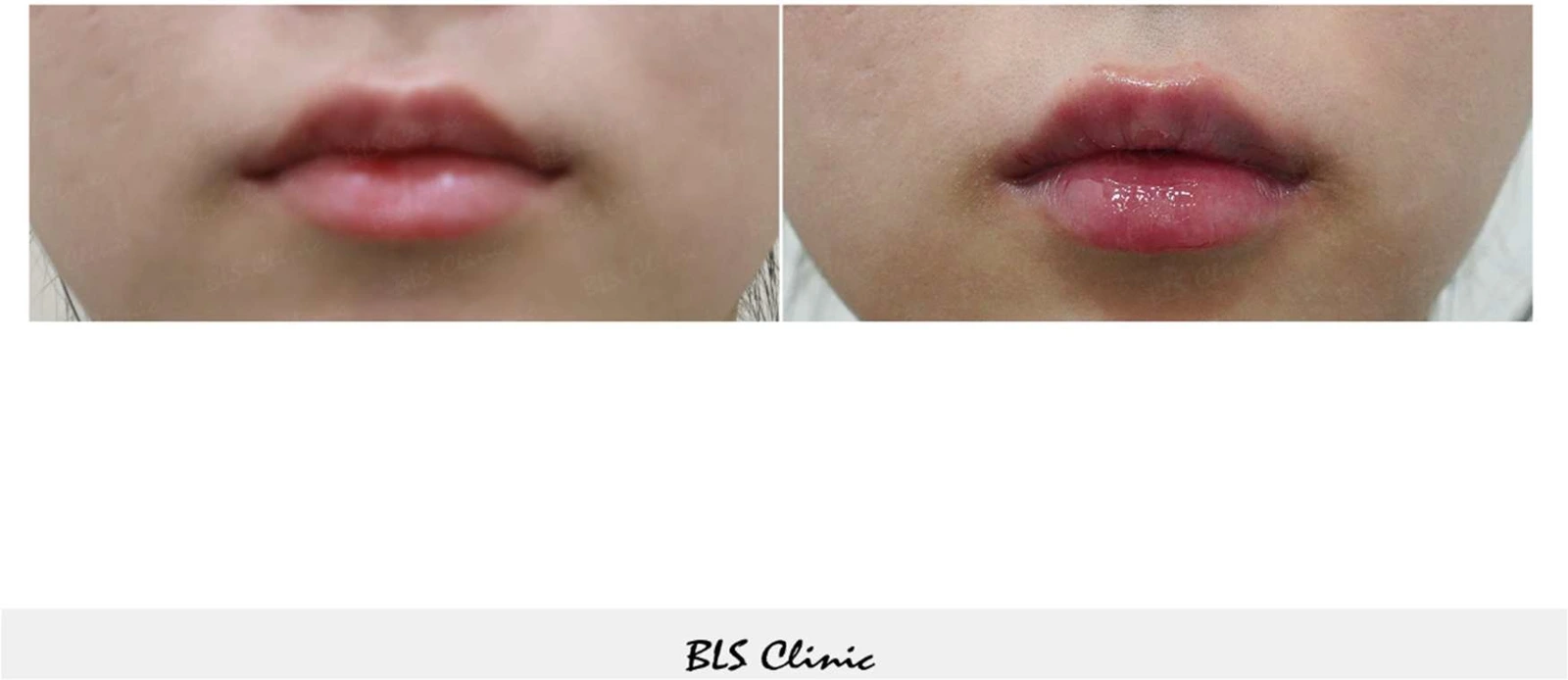 Lip fillers — front view at BLS Clinic Myeongdong. Front-facing lip comparison, including the Cupid’s bow and lower lip. Before on the left; after on the right.