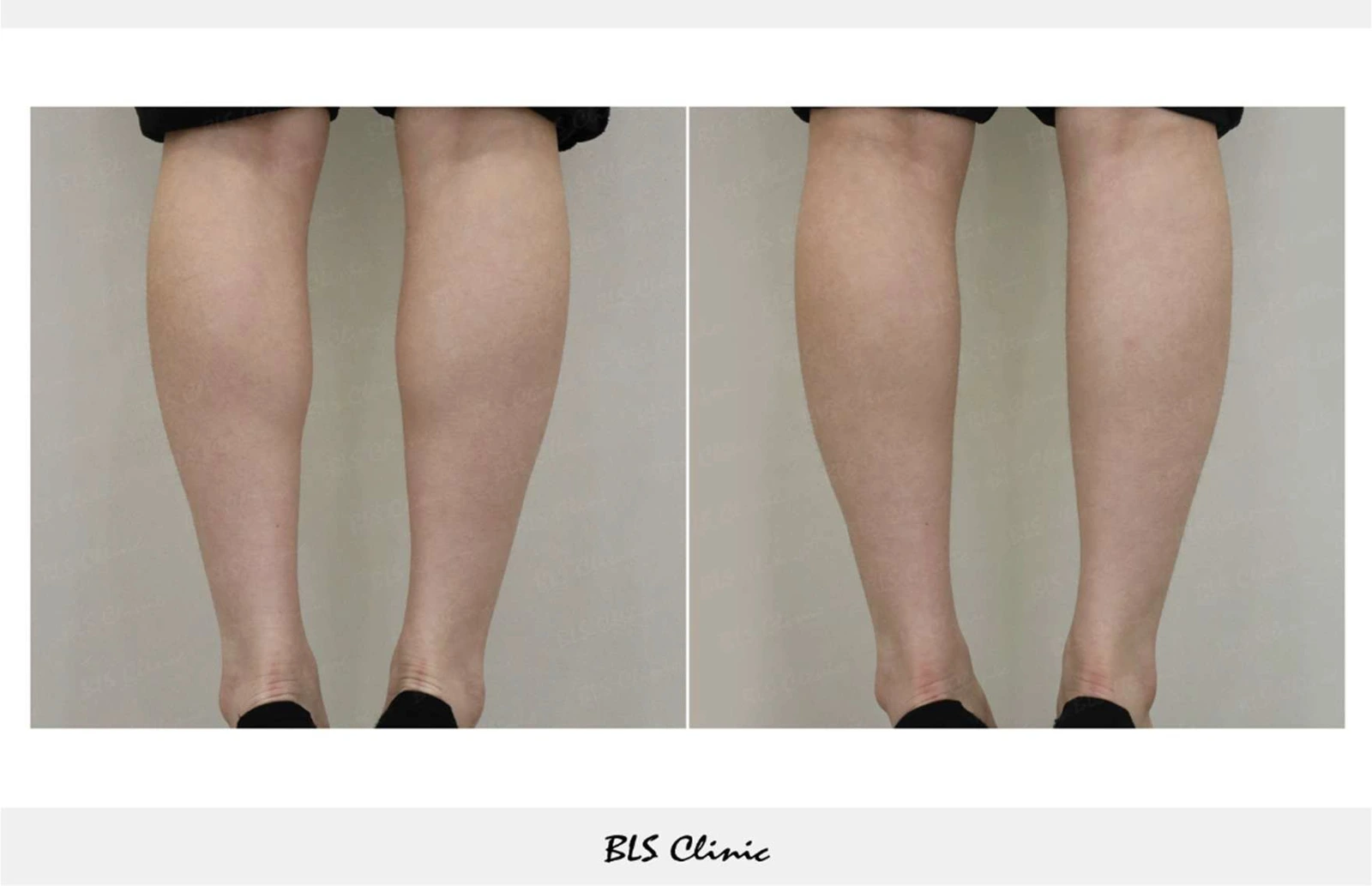 Calf botulinum toxin — rear view at BLS Clinic Myeongdong. Rear view of both calves. Before on the left; after on the right.