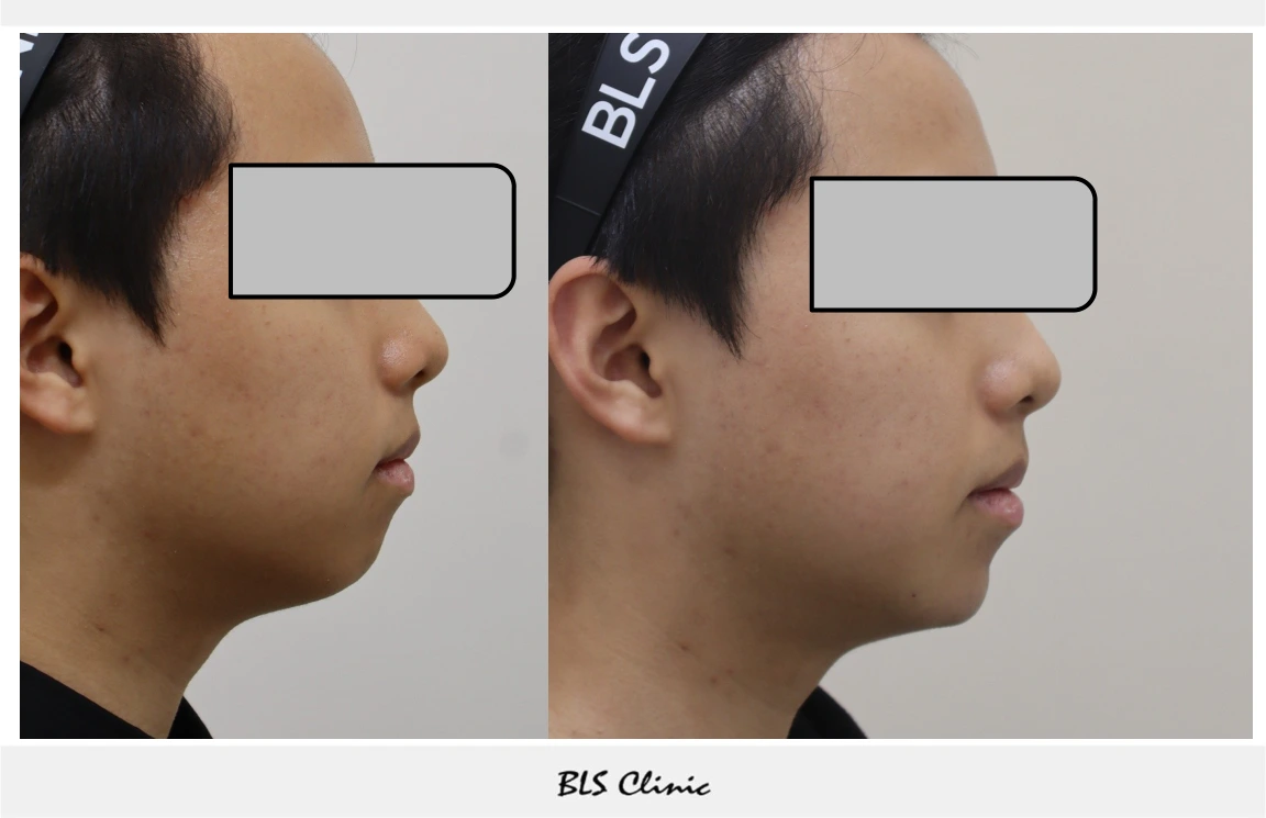 Chin fillers — side profile at BLS Clinic Myeongdong. Side profile of the chin, lips and lower jaw. Before on the left; after on the right.