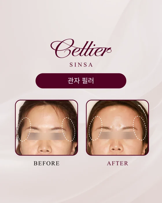 Temple fillers — comparison 1 before and after at Cellier Clinic