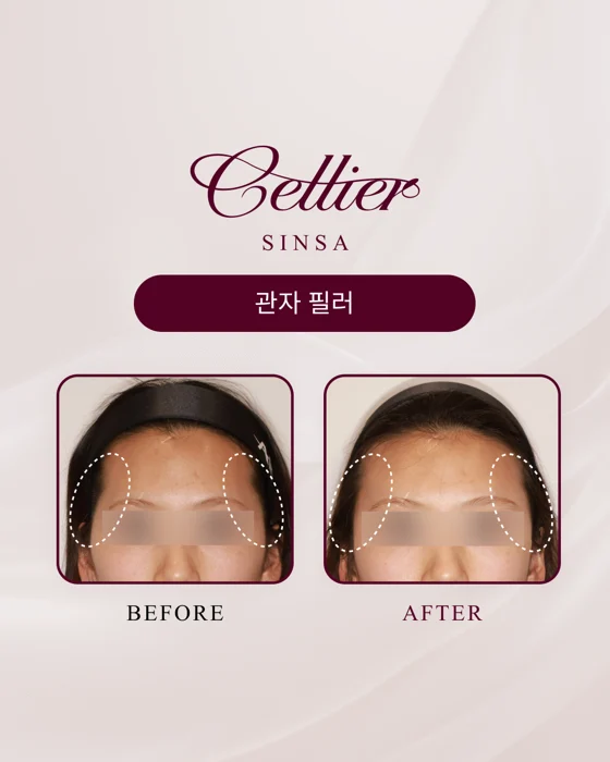 Temple fillers — comparison 2 before and after at Cellier Clinic