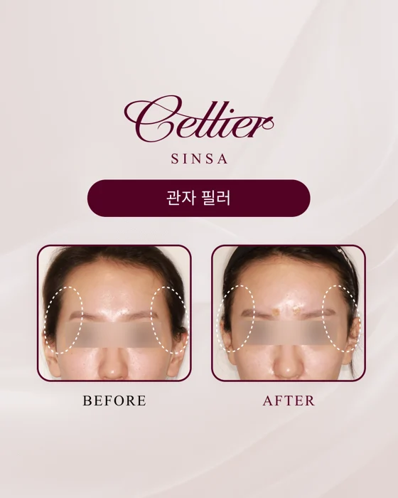 Temple fillers — comparison 3 before and after at Cellier Clinic
