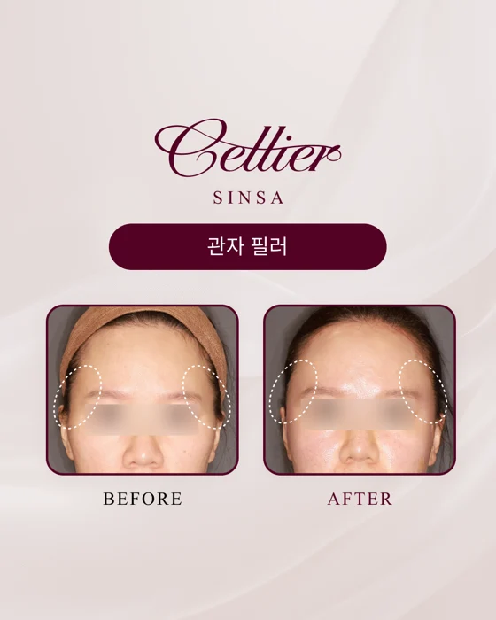 Temple fillers — comparison 4 before and after at Cellier Clinic