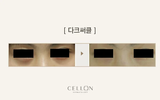 Dark-circle concerns: both under-eye areas at Cellon Dermatology. Dark-circle concerns: both under-eye areas. Before on the left and after on the right, following the clinic’s comparison layout. Follow-up timing is not supplied.
