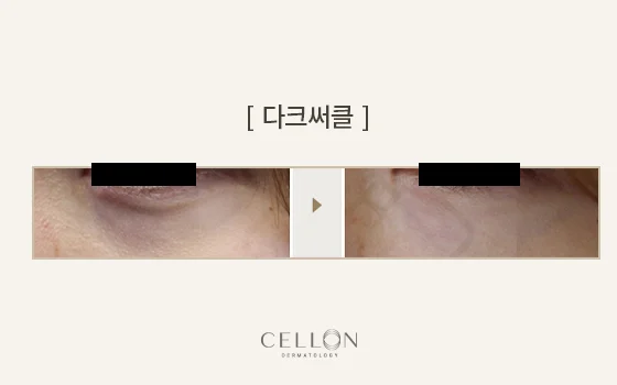 Dark-circle concerns: single under-eye close-up at Cellon Dermatology. Dark-circle concerns: single under-eye close-up. Before on the left and after on the right, following the clinic’s comparison layout. Follow-up timing is not supplied.