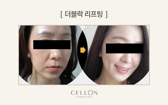 Double Lock lifting: facial comparison with different expressions at Cellon Dermatology. Double Lock lifting: facial comparison with different expressions. Before on the left and after on the right, following the clinic’s comparison layout. Follow-up timing is not supplied.