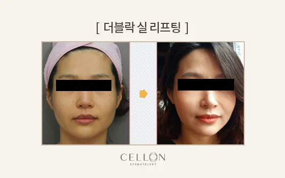 Double Lock thread lifting: front views at Cellon Dermatology. Double Lock thread lifting: front views. Before on the left and after on the right, following the clinic’s comparison layout. Follow-up timing is not supplied.