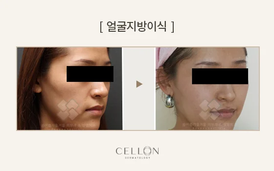 Facial fat grafting: angled facial contours at Cellon Dermatology. Facial fat grafting: angled facial contours. Before on the left and after on the right, following the clinic’s comparison layout. Follow-up timing is not supplied.