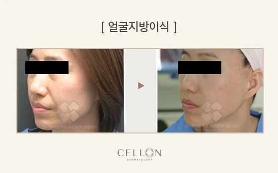 Facial fat grafting: cheek and profile views at Cellon Dermatology. Facial fat grafting: cheek and profile views. Before on the left and after on the right, following the clinic’s comparison layout. Follow-up timing is not supplied.