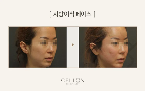 Facial fat grafting: temple and cheek comparison at Cellon Dermatology. Facial fat grafting: temple and cheek comparison. Before on the left and after on the right, following the clinic’s comparison layout. Follow-up timing is not supplied.