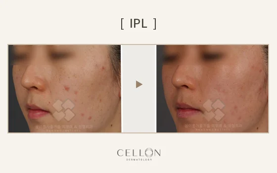 IPL: cheek redness and pigmentation comparison at Cellon Dermatology. IPL: cheek redness and pigmentation comparison. Before on the left and after on the right, following the clinic’s comparison layout. Follow-up timing is not supplied.