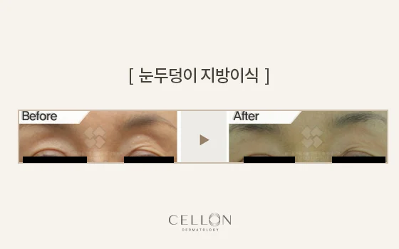 Upper-eyelid fat grafting: close-up comparison at Cellon Dermatology. Upper-eyelid fat grafting: close-up comparison. Before on the left and after on the right, following the clinic’s comparison layout. Follow-up timing is not supplied.