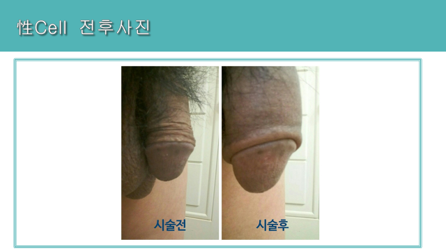 Seong Cell men’s treatment: upright comparison at Cheongdam Cell Clinic. Cheongdam Cell Clinic, Seoul — seong cell men’s treatment: upright comparison. Clinic-supplied before-and-after comparison board.
