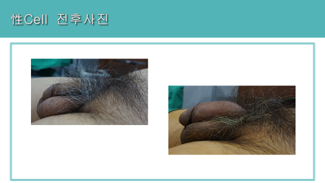 Seong Cell men’s treatment: lateral comparison at Cheongdam Cell Clinic. Cheongdam Cell Clinic, Seoul — seong cell men’s treatment: lateral comparison. Clinic-supplied before-and-after comparison board.