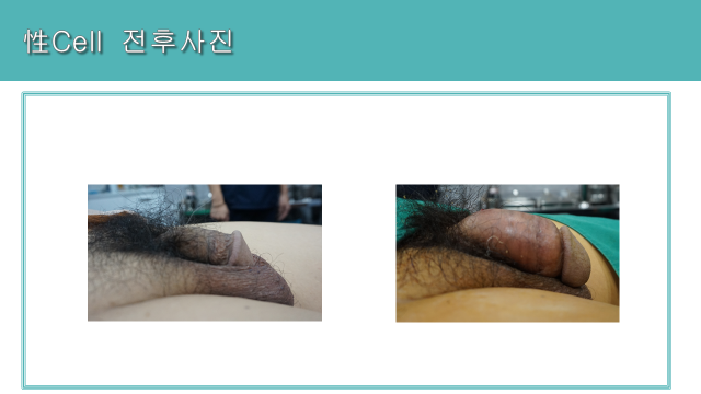 Seong Cell men’s treatment: close side views at Cheongdam Cell Clinic. Cheongdam Cell Clinic, Seoul — seong cell men’s treatment: close side views. Clinic-supplied before-and-after comparison board.