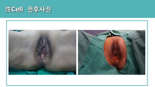 Seong Cell women’s treatment: frontal comparison at Cheongdam Cell Clinic. Cheongdam Cell Clinic, Seoul — seong cell women’s treatment: frontal comparison. Clinic-supplied before-and-after comparison board.