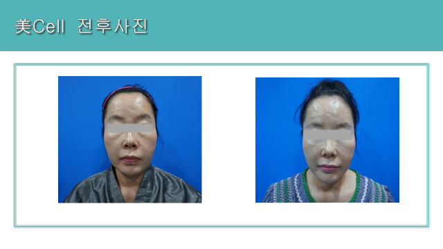 Mi Cell facial program: front-facing comparison at Cheongdam Cell Clinic. Cheongdam Cell Clinic, Seoul — mi cell facial program: front-facing comparison. Clinic-supplied before-and-after comparison board.