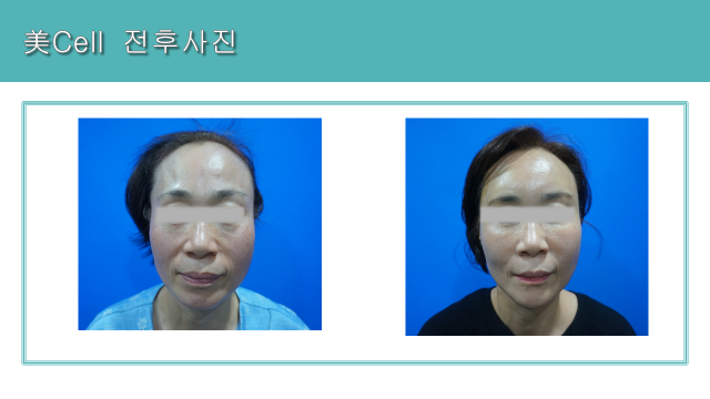 Mi Cell facial program: cheeks and lower-face view at Cheongdam Cell Clinic. Cheongdam Cell Clinic, Seoul — mi cell facial program: cheeks and lower-face view. Clinic-supplied before-and-after comparison board.