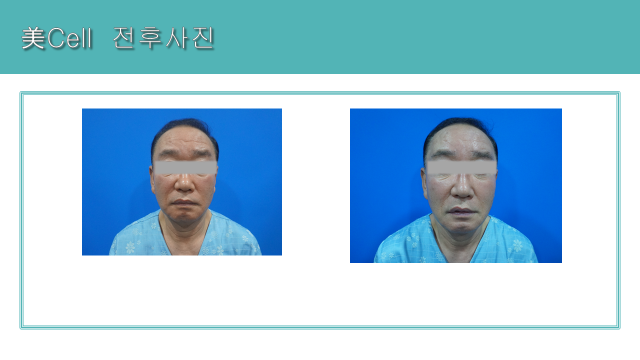 Mi Cell facial program: facial contour comparison at Cheongdam Cell Clinic. Cheongdam Cell Clinic, Seoul — mi cell facial program: facial contour comparison. Clinic-supplied before-and-after comparison board.