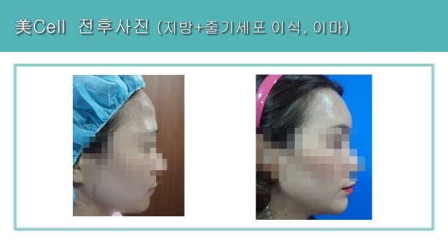Forehead fat and stem-cell grafting: profile comparison at Cheongdam Cell Clinic. Cheongdam Cell Clinic, Seoul — forehead fat and stem-cell grafting: profile comparison. Clinic-supplied before-and-after comparison board.