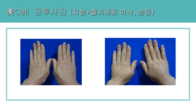 Hand fat and stem-cell grafting: back-of-hand comparison at Cheongdam Cell Clinic. Cheongdam Cell Clinic, Seoul — hand fat and stem-cell grafting: back-of-hand comparison. Clinic-supplied before-and-after comparison board.