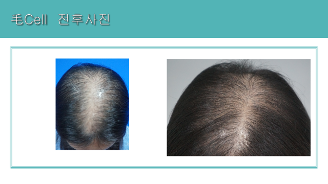 Mo Cell hair program: central-part comparison at Cheongdam Cell Clinic. Cheongdam Cell Clinic, Seoul — mo cell hair program: central-part comparison. Clinic-supplied before-and-after comparison board.