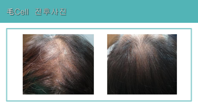 Mo Cell hair program: crown comparison at Cheongdam Cell Clinic. Cheongdam Cell Clinic, Seoul — mo cell hair program: crown comparison. Clinic-supplied before-and-after comparison board.