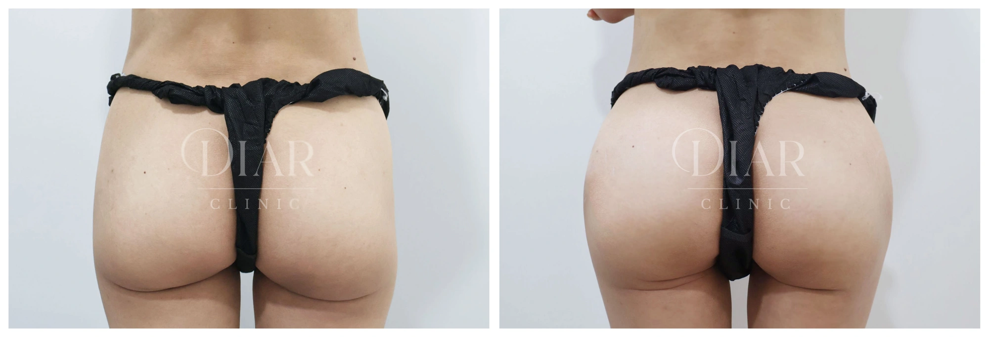 Buttock filler — comparison 01 at Diar Clinic. Diar Clinic, Seoul: buttock filler — comparison 01; two supplied views of the buttock area arranged side by side.