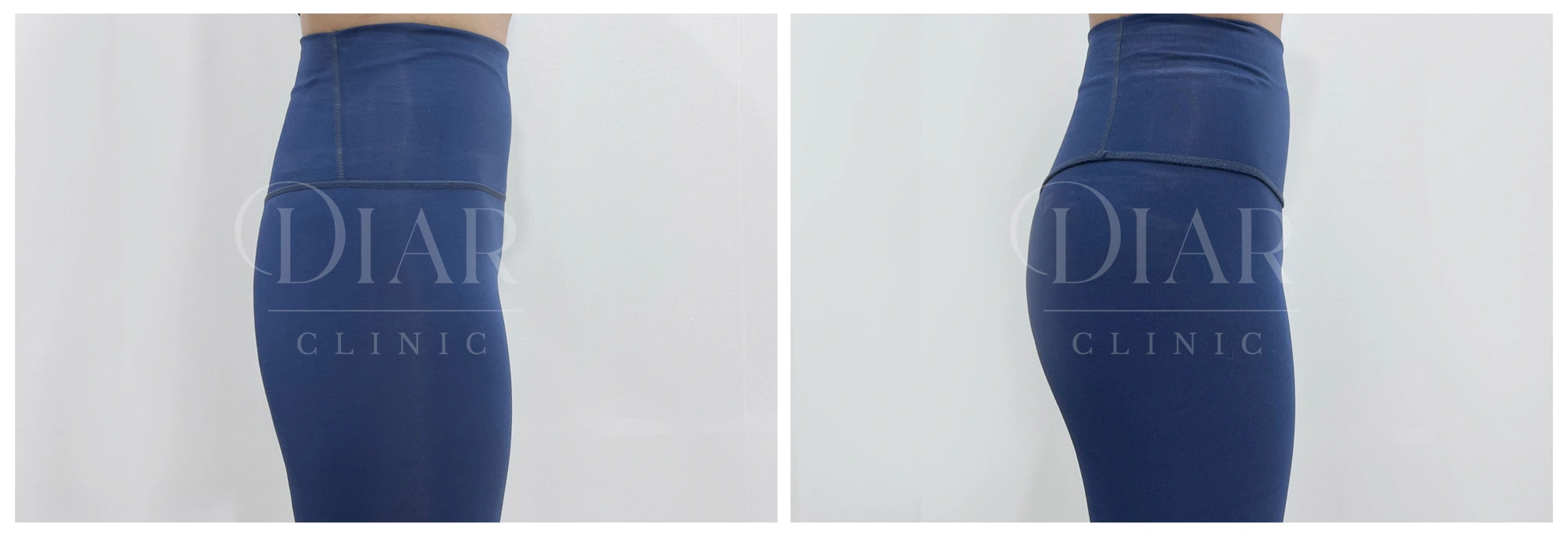 Buttock filler — comparison 03 at Diar Clinic. Diar Clinic, Seoul: buttock filler — comparison 03; two supplied views of the buttock area arranged side by side.