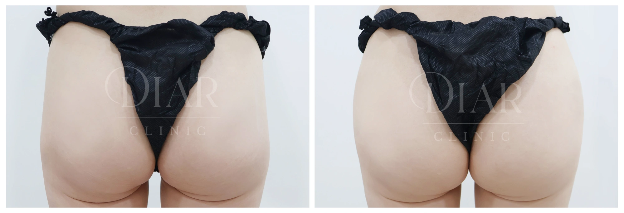 Buttock filler — comparison 04 at Diar Clinic. Diar Clinic, Seoul: buttock filler — comparison 04; two supplied views of the buttock area arranged side by side.