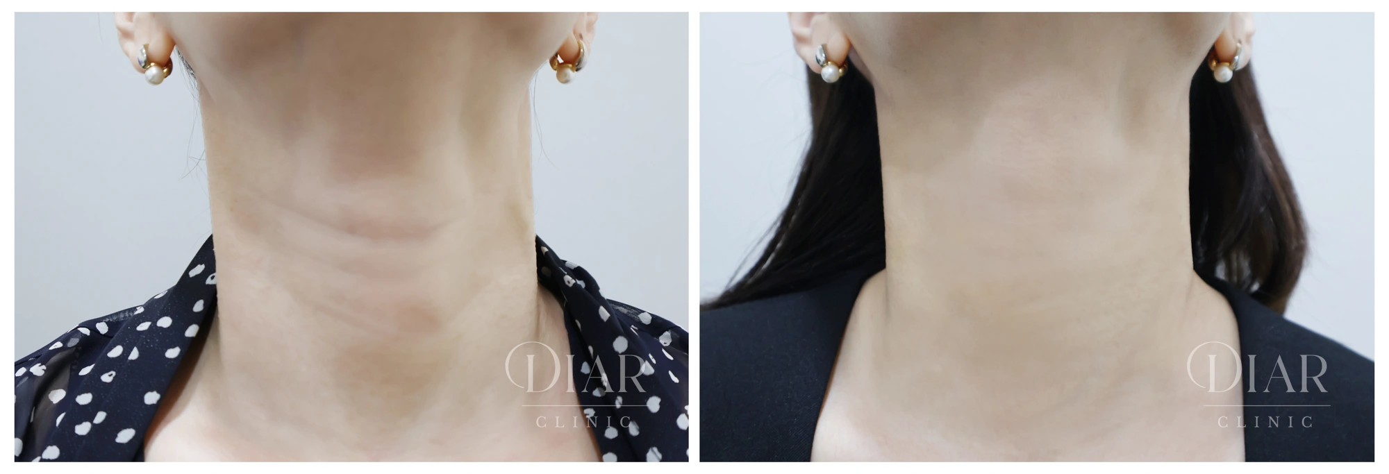Neck filler — comparison 01 at Diar Clinic. Diar Clinic, Seoul: neck filler — comparison 01; two supplied views of the neck area arranged side by side.