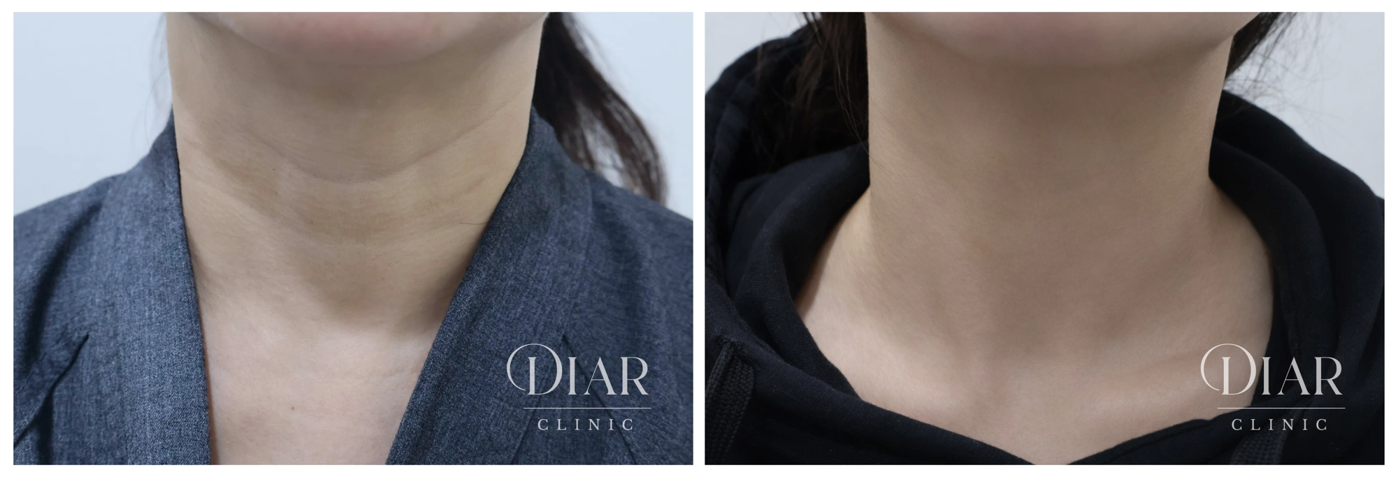 Neck filler — comparison 02 at Diar Clinic. Diar Clinic, Seoul: neck filler — comparison 02; two supplied views of the neck area arranged side by side.