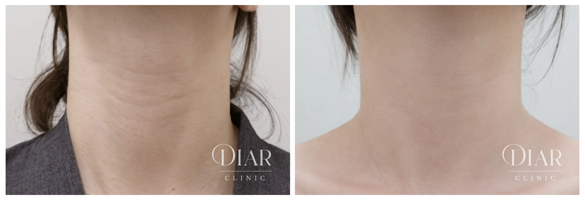 Neck filler — comparison 03 at Diar Clinic. Diar Clinic, Seoul: neck filler — comparison 03; two supplied views of the neck area arranged side by side.