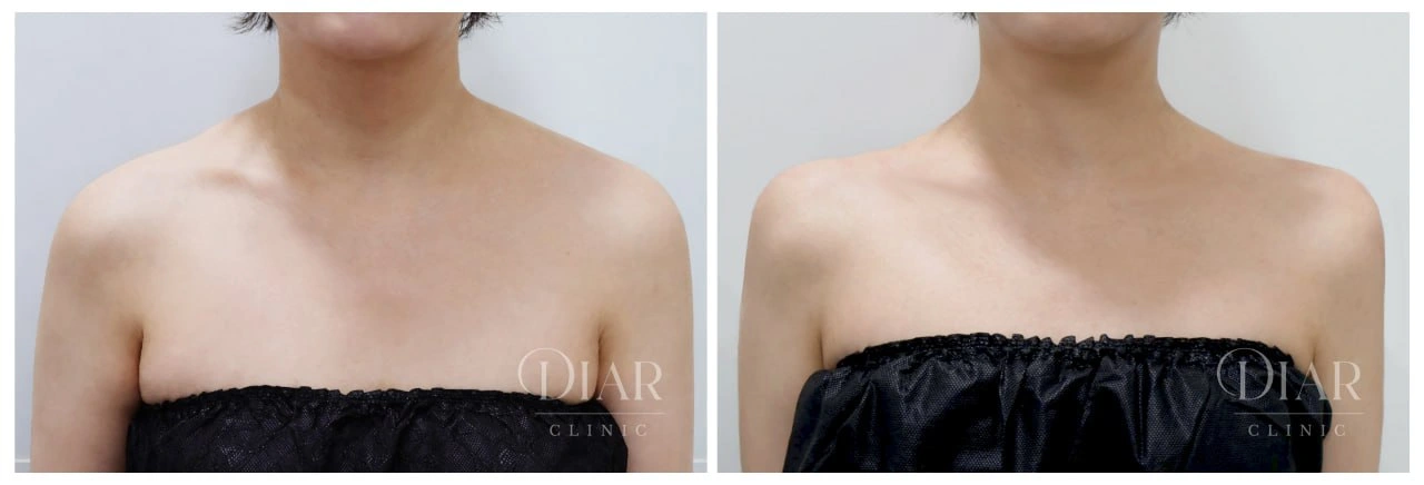 Shoulder contour — comparison 01 at Diar Clinic. Diar Clinic, Seoul: shoulder contour — comparison 01; two supplied views of the shoulder area arranged side by side.