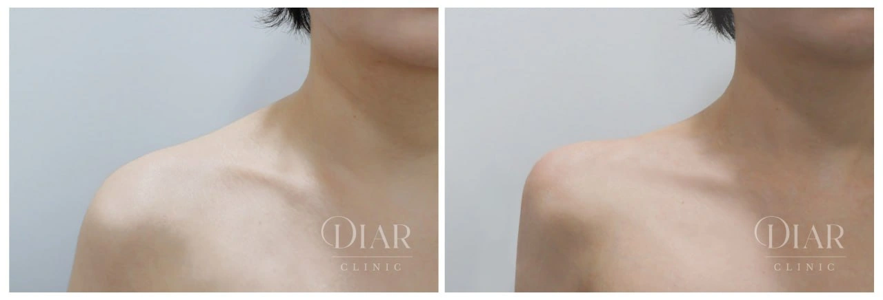 Shoulder contour — comparison 02 at Diar Clinic. Diar Clinic, Seoul: shoulder contour — comparison 02; two supplied views of the shoulder area arranged side by side.