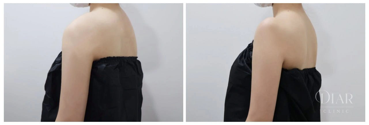 Shoulder contour — comparison 03 at Diar Clinic. Diar Clinic, Seoul: shoulder contour — comparison 03; two supplied views of the shoulder area arranged side by side.