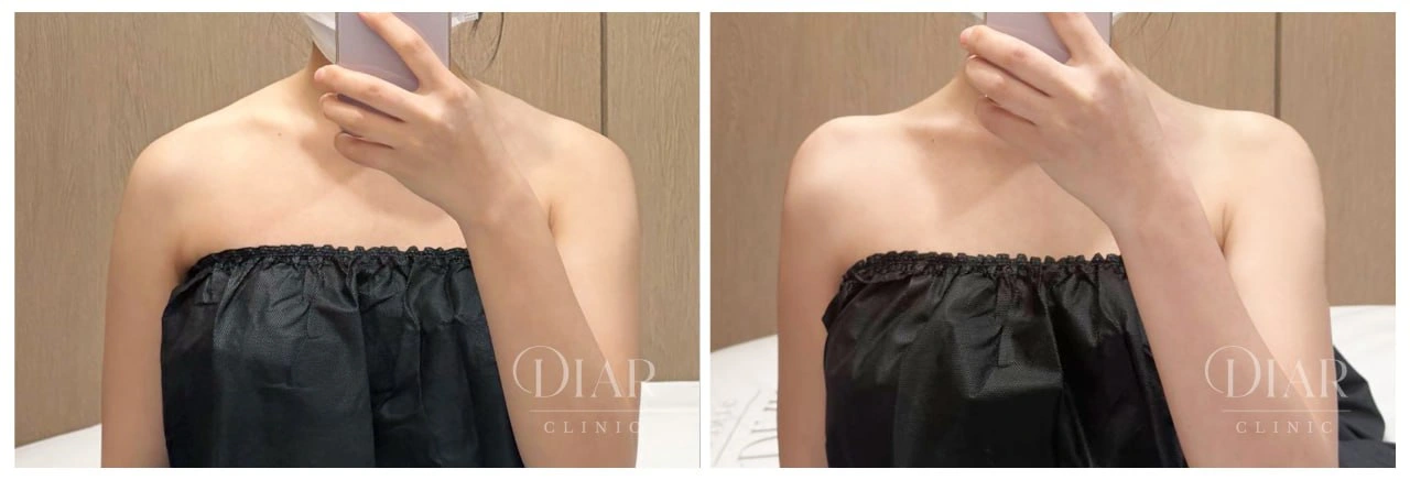 Shoulder contour — comparison 04 at Diar Clinic. Diar Clinic, Seoul: shoulder contour — comparison 04; two supplied views of the shoulder area arranged side by side.
