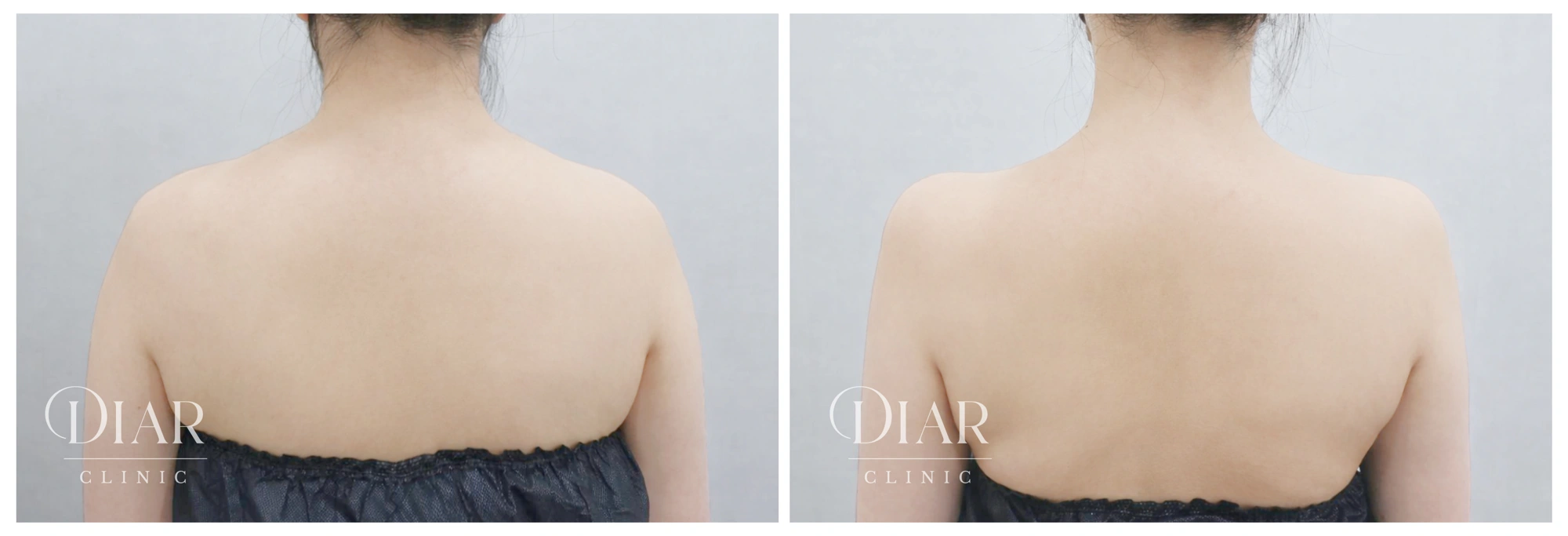 Shoulder filler — comparison 06 at Diar Clinic. Diar Clinic, Seoul: shoulder filler — comparison 06; two supplied views of the shoulder area arranged side by side.