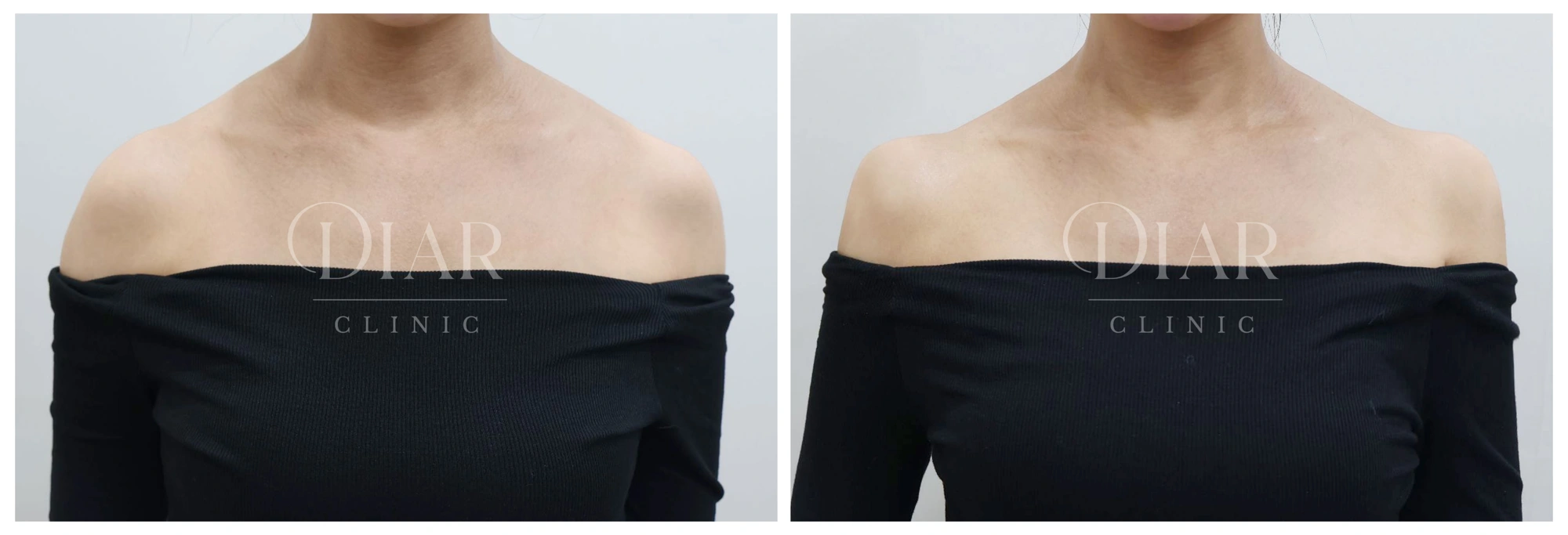 Shoulder filler — comparison 08 at Diar Clinic. Diar Clinic, Seoul: shoulder filler — comparison 08; two supplied views of the shoulder area arranged side by side.