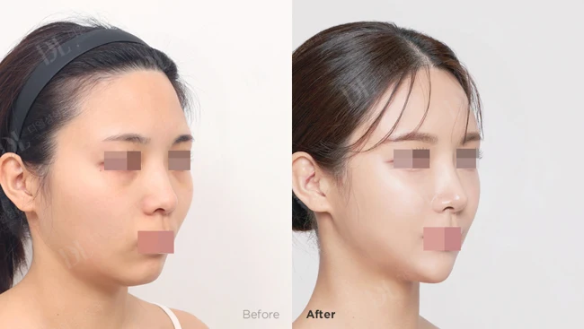 Combined facial contouring and nose surgery at three months at DL Plastic Surgery. Before on the left; after on the right. Angled view at a clinic-labelled three-month follow-up. Original eye and mouth masking retained.