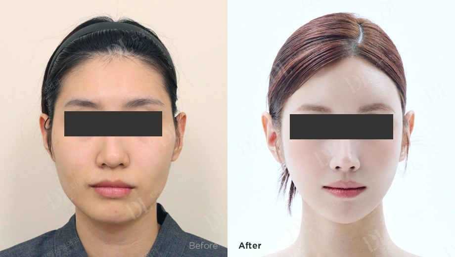 Combined facial surgery: front-view comparison at DL Plastic Surgery. Before on the left; after on the right. Front view. Eyes covered for privacy; follow-up timing not supplied.