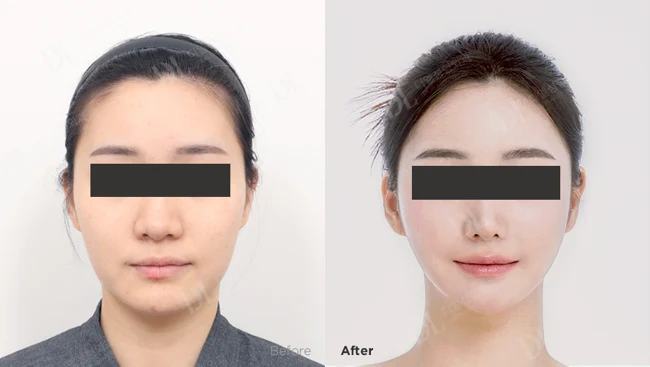 Facial liposuction and lifting: front view at DL Plastic Surgery. Before on the left; after on the right. Front view. Eyes covered for privacy; follow-up timing not supplied.