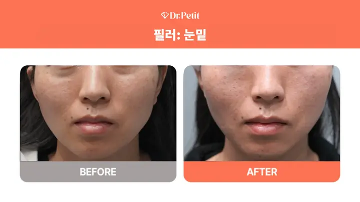 Under-eye filler: cheek and tear-trough detail at Doctorpetit Clinic Hongdae. Doctorpetit Clinic Hongdae — Under-eye filler: cheek and tear-trough detail. Before on the left and after on the right; follow-up interval not supplied.