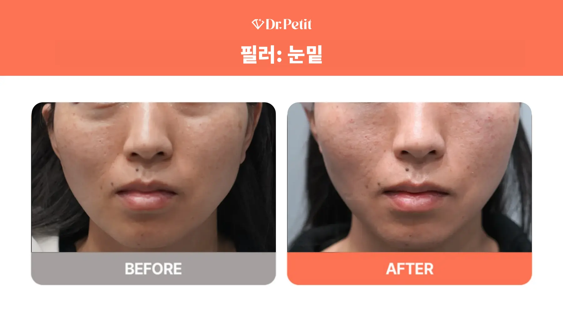Under-eye filler: cheek and tear-trough detail at Doctorpetit Clinic Hongdae. Doctorpetit Clinic Hongdae — Under-eye filler: cheek and tear-trough detail. Before on the left and after on the right; follow-up interval not supplied.