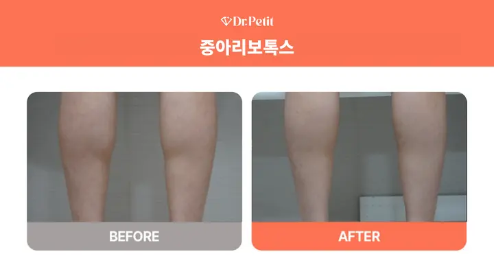 Calf Botox: rear lower-leg comparison at Doctorpetit Clinic Hongdae. Doctorpetit Clinic Hongdae — Calf Botox: rear lower-leg comparison. Before on the left and after on the right; follow-up interval not supplied.