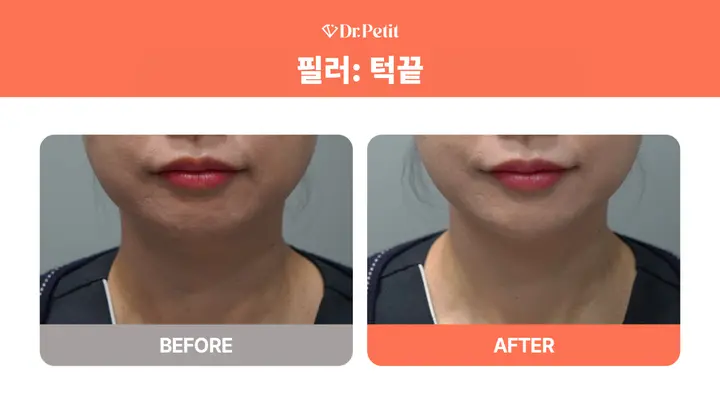 Chin filler: lower-face outline at Doctorpetit Clinic Hongdae. Doctorpetit Clinic Hongdae — Chin filler: lower-face outline. Before on the left and after on the right; follow-up interval not supplied.